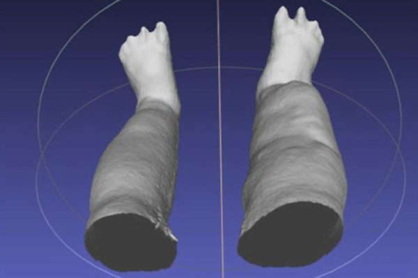 Portable 3-D scanner assesses patients with elephantiasis