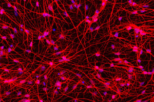 Huntington's disease cells