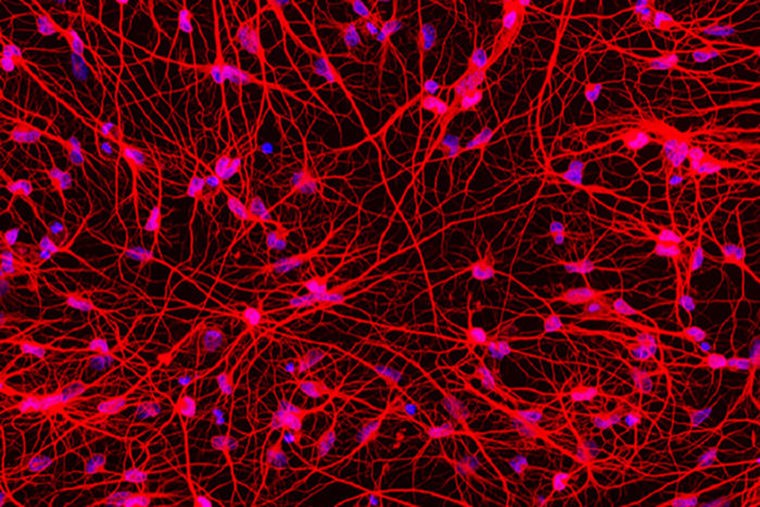 Huntington's disease cells