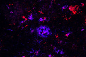Antibodies against APOE (red) bind to amyloid plaques (blue) in brain tissue