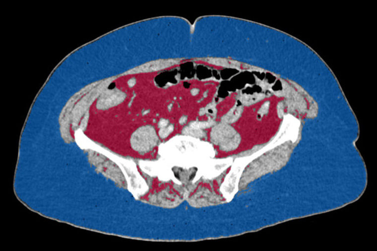 CT scan of female kidney cancer patient shows relatively little visceral fat and more subcutaneous fat