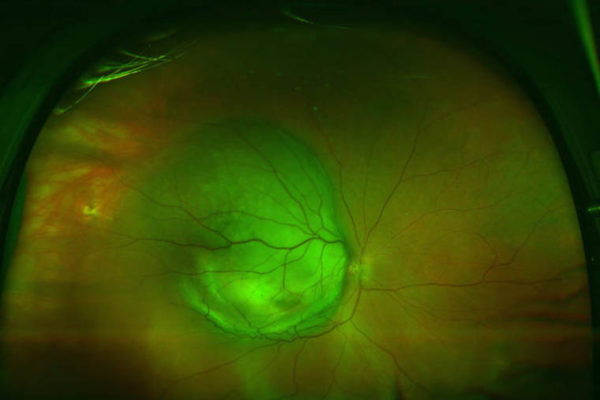 Scientists identify weak point in deadly eye melanoma