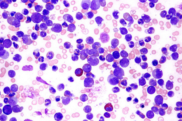 $11.5 million supports innovation in leukemia research