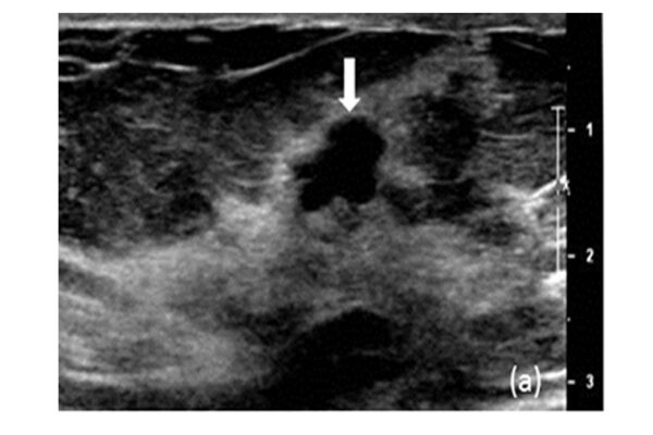 Novel imaging technology may help reduce biopsies for breast tumors