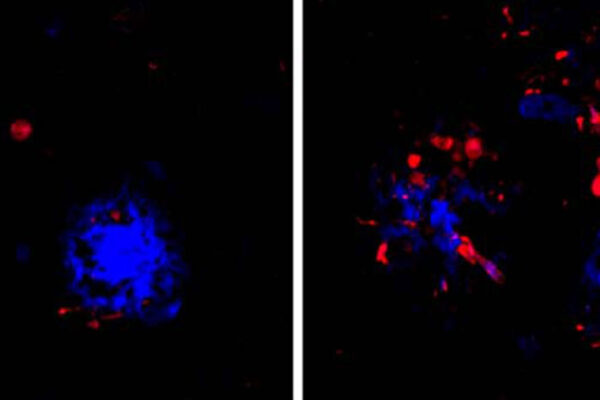 Alzheimer’s missing link ID’d, answering what tips brain’s decline