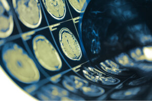 MRI images of a brain