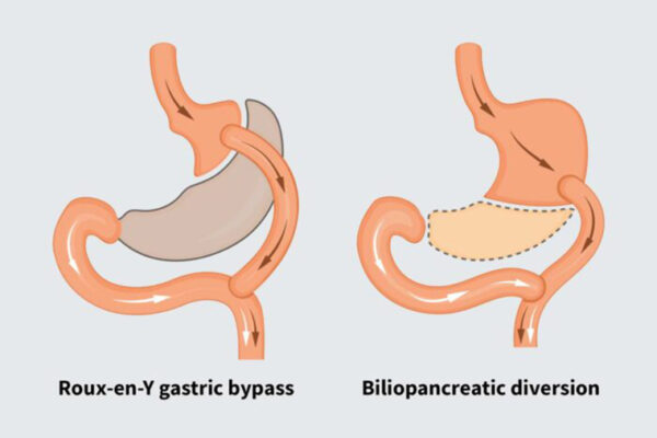 Uncommon weight-loss surgery best for reducing diabetes risk