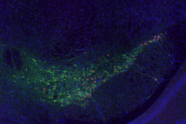 Gene ID’d as potential therapeutic target for dementia in Parkinson’s