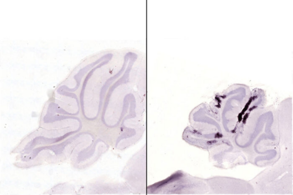 Why Zika virus caused most harmful brain damage to Brazilian newborns