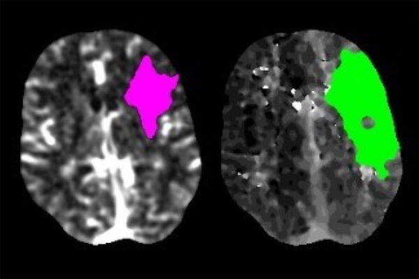 Stroke evaluations drop by nearly 40% during COVID-19 pandemic