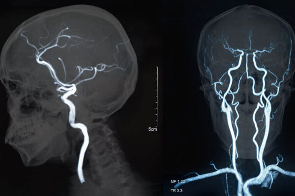 Stroke survival rates worse in rural areas, study says