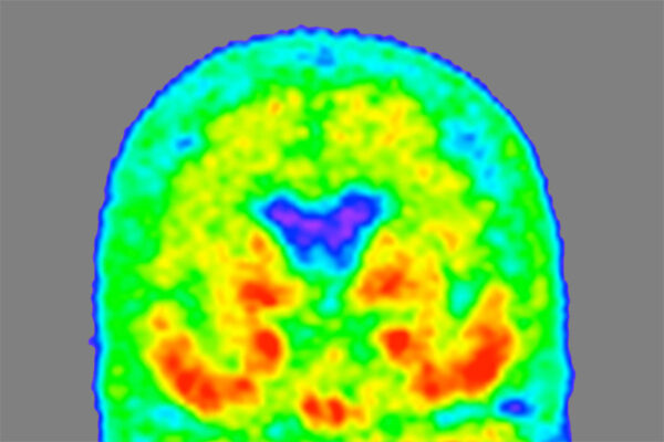 Novel form of Alzheimer’s protein found in spinal fluid indicates stage of the disease