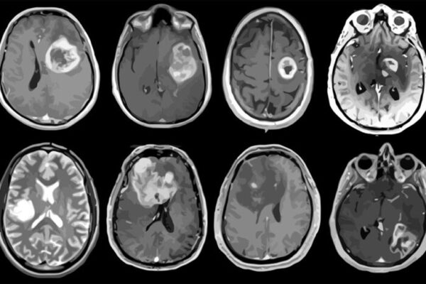 Aggressive brain tumor mapped in genetic, molecular detail