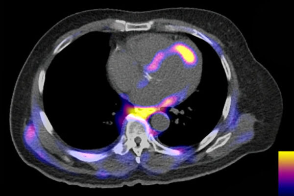 Immune therapies for heart disease aim of international research network