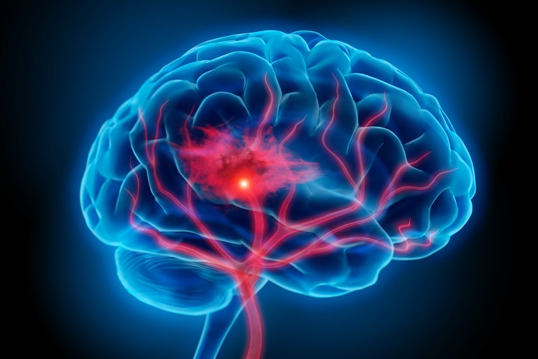 Illustration of a brain with a stroke