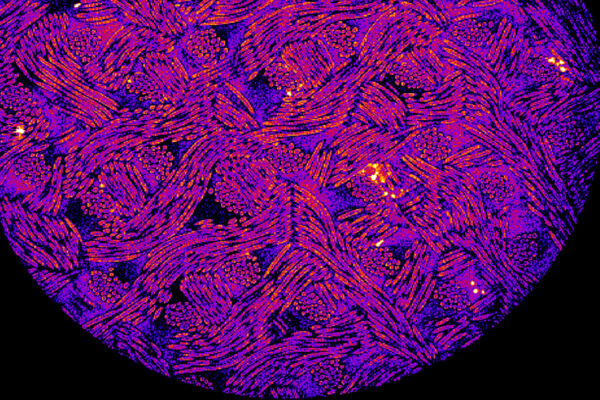 Rheumatoid arthritis treated with implanted cells that release drug