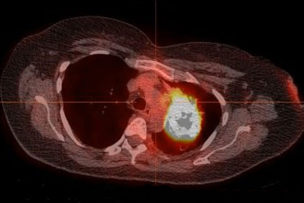 Most cases of never-smokers’ lung cancer treatable with mutation-targeting drugs