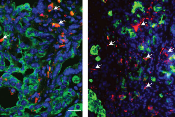 Drug compound makes pancreatic cancer cells more vulnerable to chemo