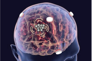 Rendering of a brain with tiny sensors attached.