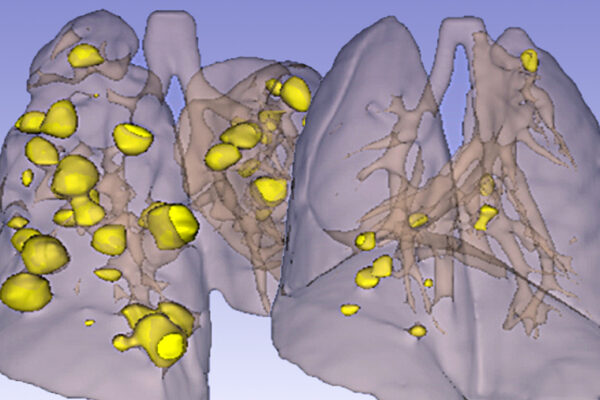 Drug combo therapy in mice blocks drug resistance, halts tumor growth