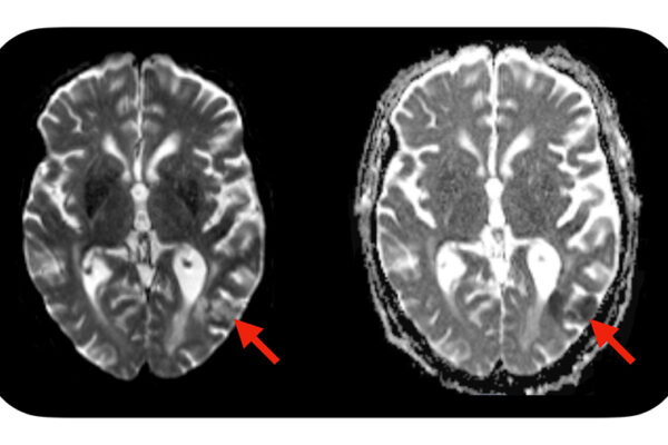 Simple blood test predicts neurotoxic complications of CAR-T cell therapy