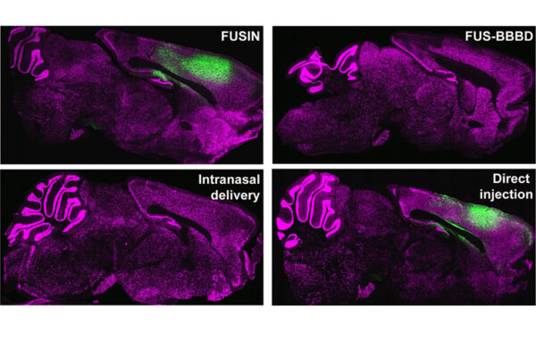 A sound approach for effective gene therapy delivery to brain