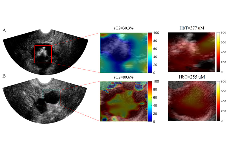 ultrasound images or a benign and a malignant lesion using Zhu's new technique