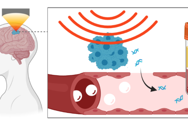 Focused ultrasound technique leads to release of neurodegenerative disorders biomarkers