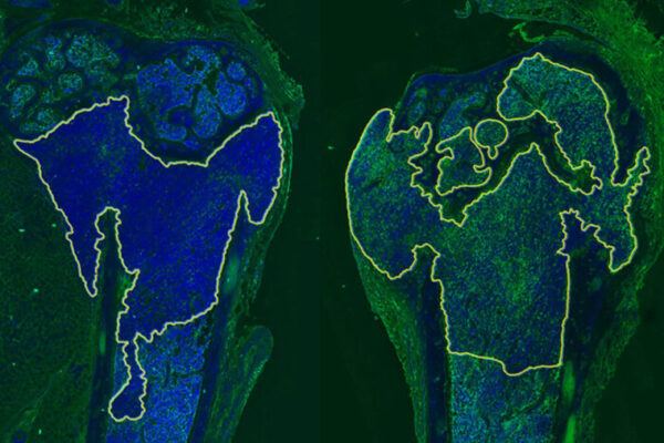 Two-pronged immunotherapy eliminates metastatic breast cancer in mice