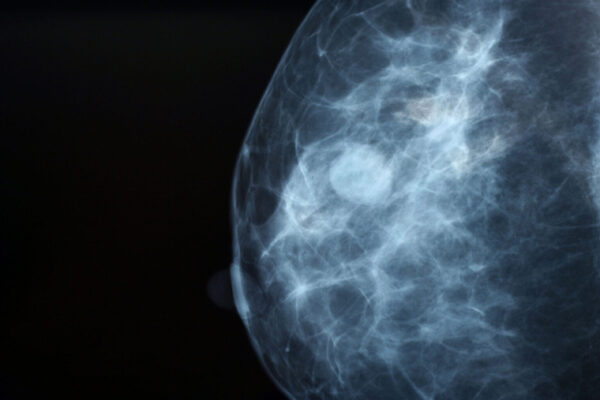 Change in breast density over time linked to cancer risk