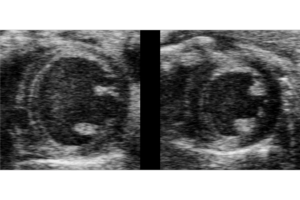 two mouse hearts with heart failure