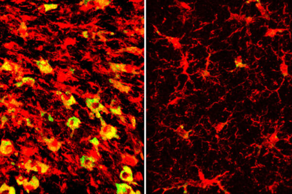 Lowering a form of brain cholesterol reduces Alzheimer’s-like damage in mice