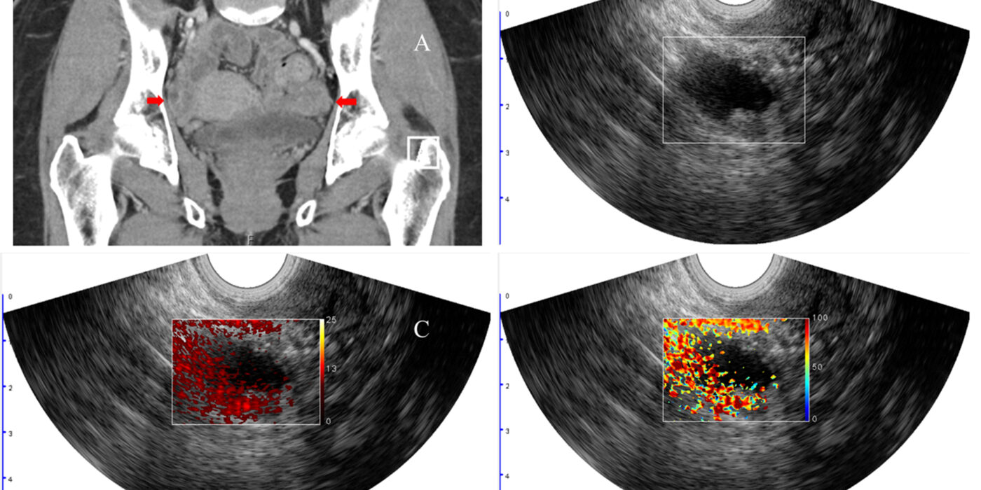 ovarian cancer images