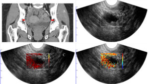 ovarian cancer images