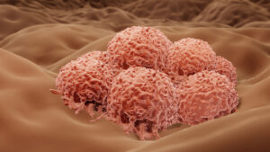 melanoma cells