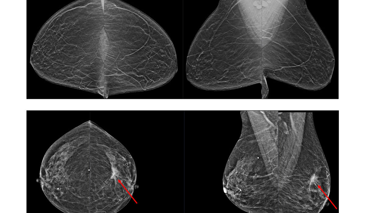 mammogram image