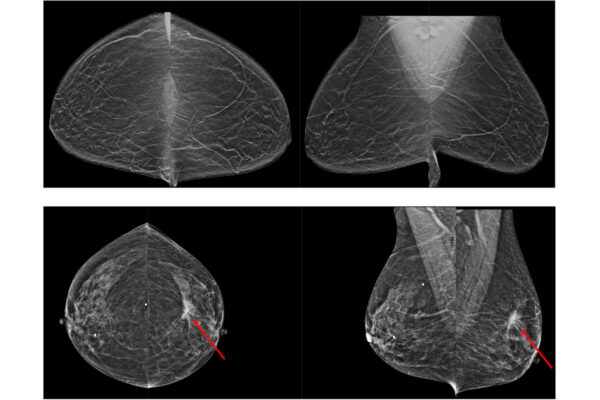 AI-assisted breast-cancer screening may reduce unnecessary testing