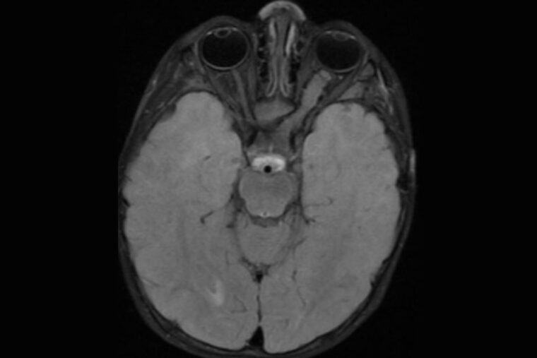 tumor on the optic nerve