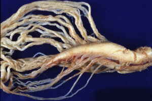 neuropathology image from ALS case