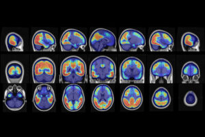 brain scans
