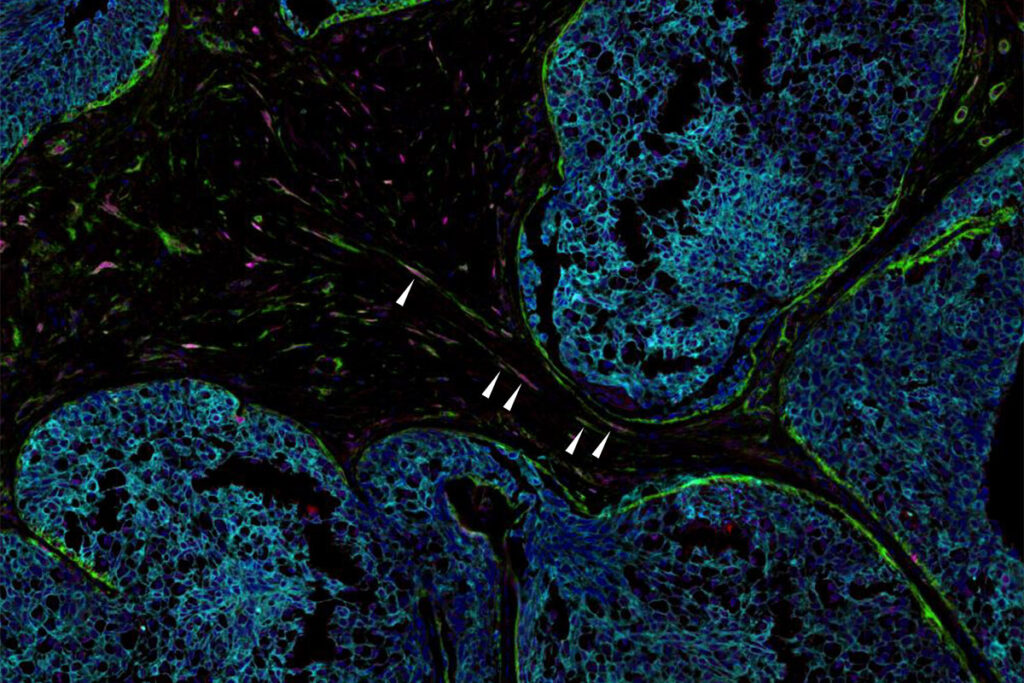 breast tumor sample