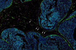 breast tumor sample