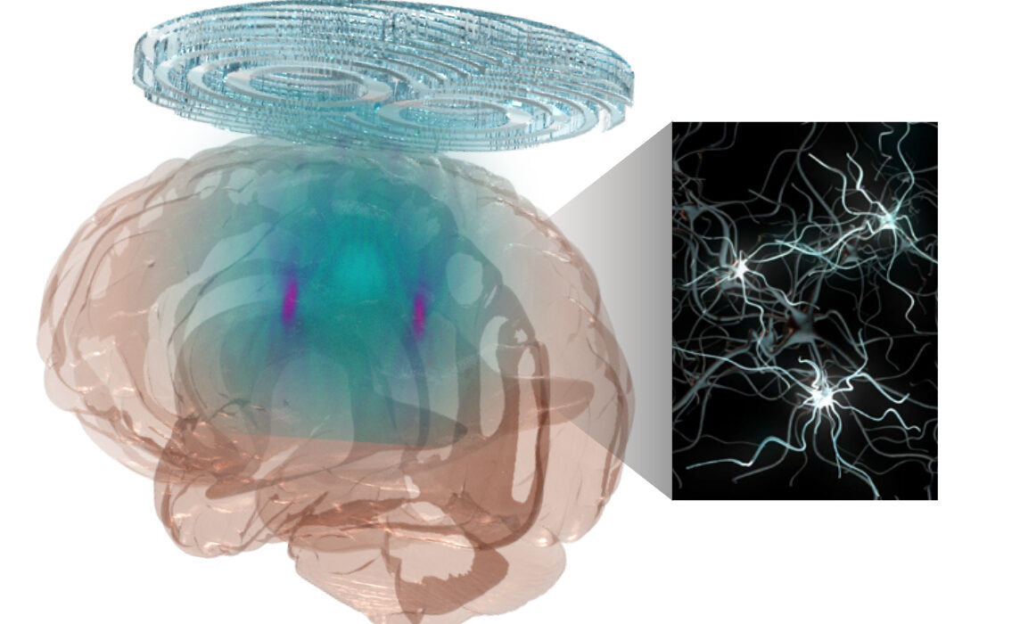 an image of how ultrasound can be used to treat neurons