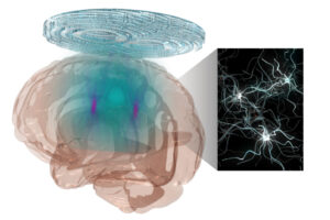 an image of how ultrasound can be used to treat neurons
