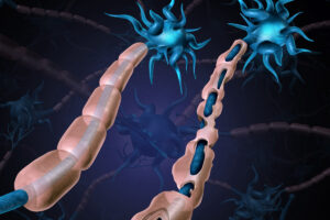 Multiple sclerosis damaged myelin