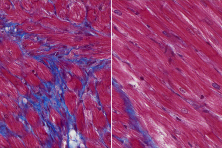 images of heart muscle scarring after cardiac injury