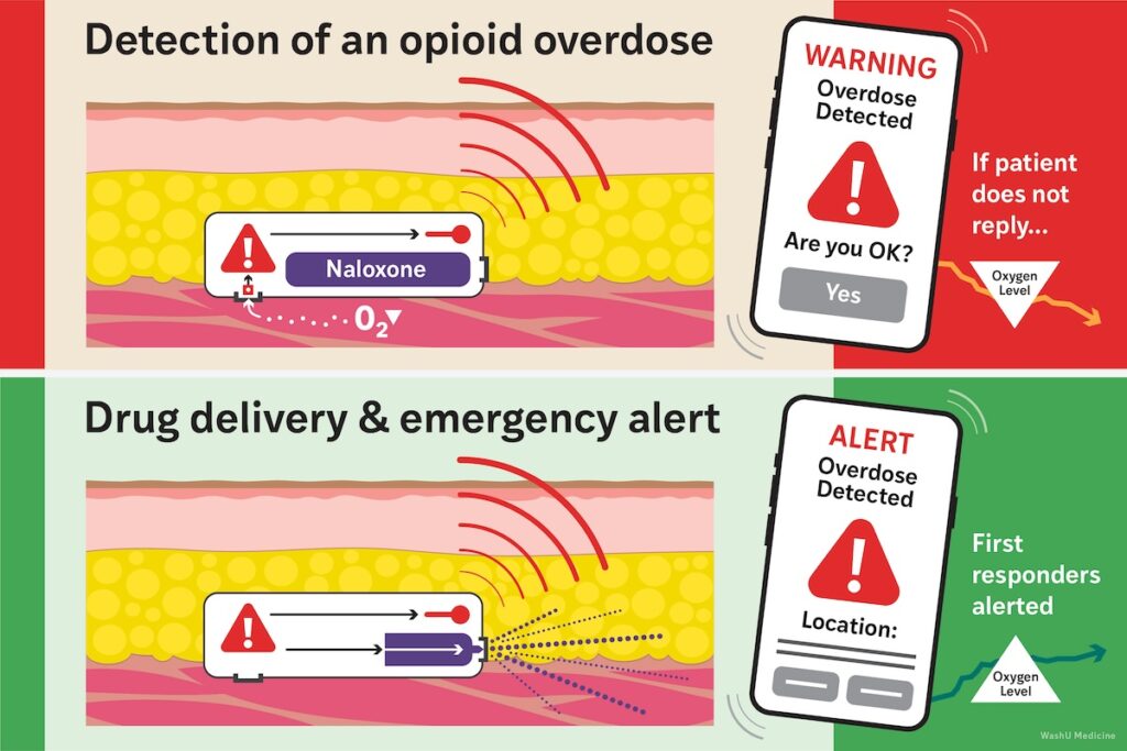 artwork showing how implant for opioid overdose works