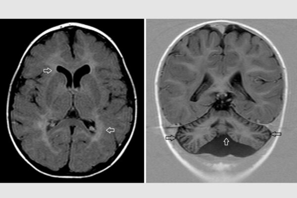 Researchers solve medical mystery of neurological symptoms in kids