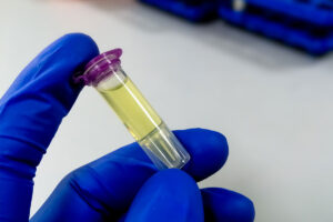 a sample of cerebrospinal fluid