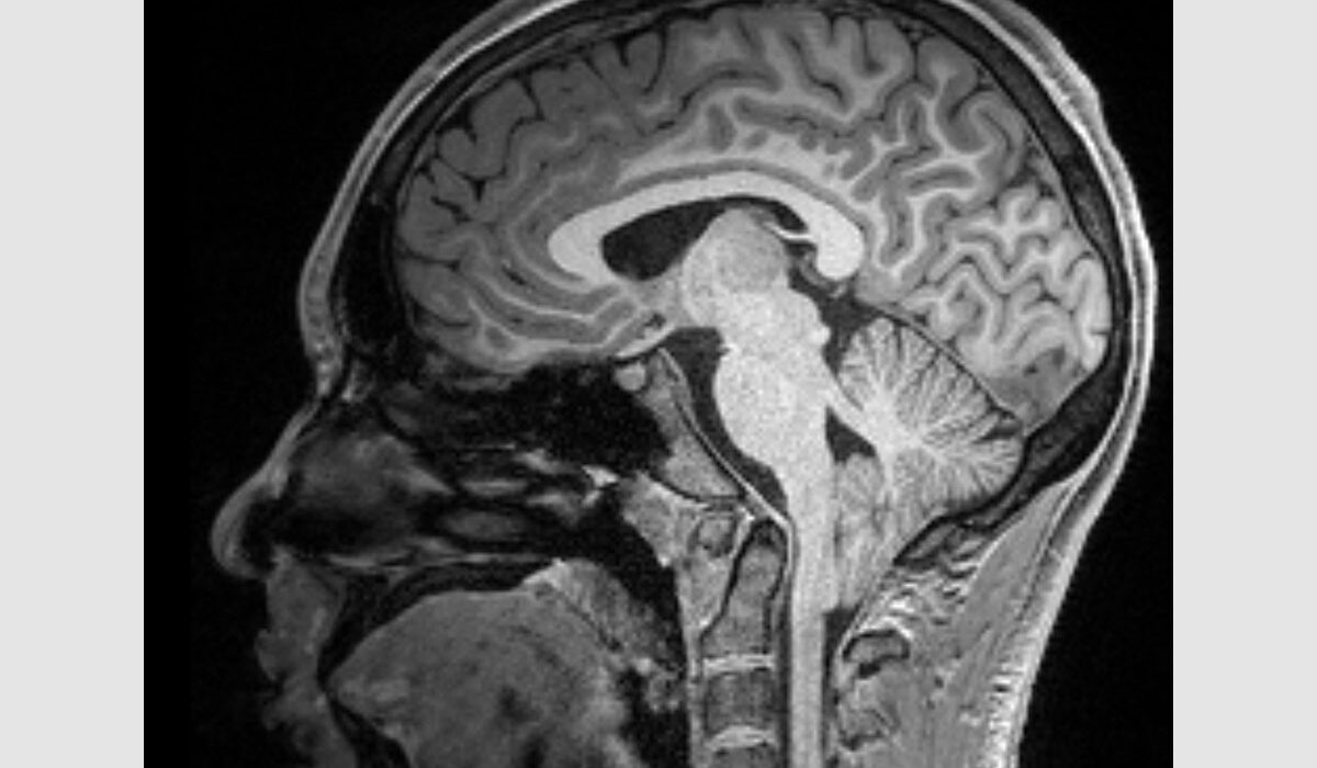 MRI scan shows a Chiari type-1 malformation